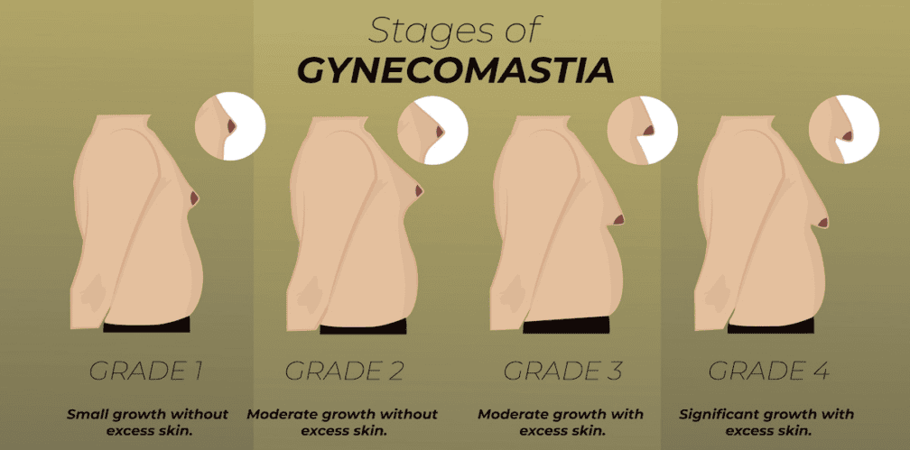 Dr Elan Reisin -Surgery for Gynecomastia